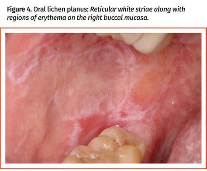 Diffuse Mildly Erythematous Mucosa Unraveled