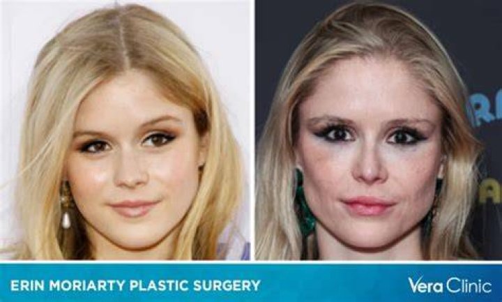 Erin Moriarty's Plastic Surgery Journey Unveiled