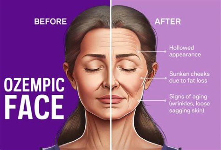Exploring the Phenomenon of Ozempic Face: Causes, Effects, and Solutions