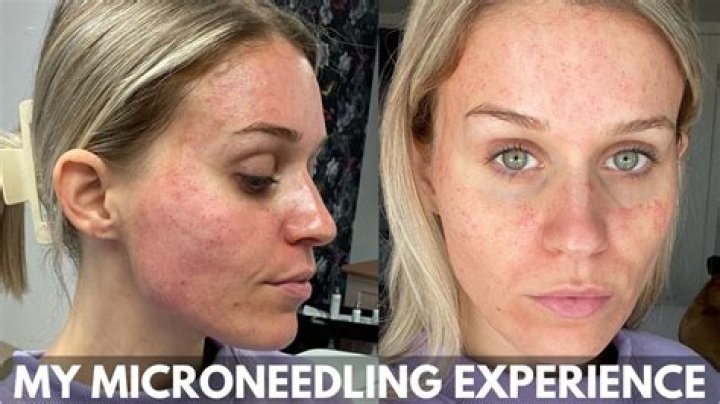 Microneedling Ruined My Skin: A Cautionary Tale