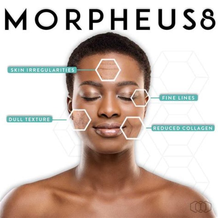 Morpheus8 Ruined My Skin: A Cautionary Tale