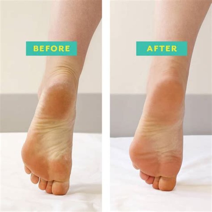 The Ultimate Guide to Achieving Perfect Feet with a Foot Peel