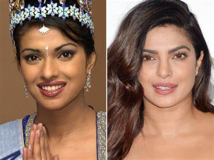 Unveiling Priyanka Chopra's Transformation: Discoveries Before Nose Surgery